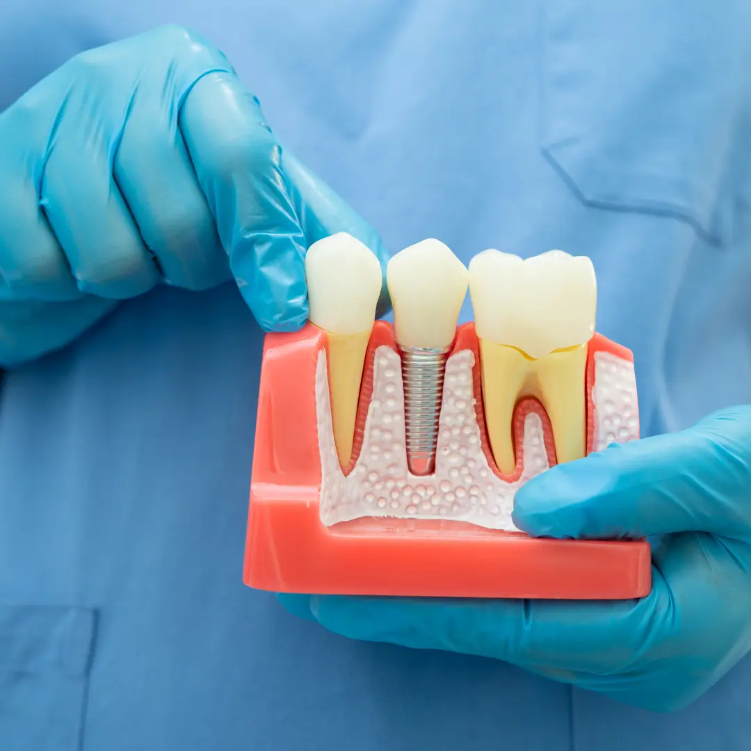Implantes